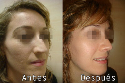 Cirugia Estetica Facial Cicatrices de Acne en Clinica BMS