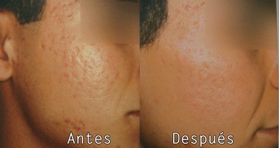 Cirugia Estetica Facial Manchas Faciales en Clinica BMS