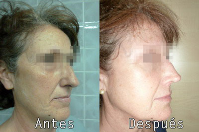 Cirugia Estética nariz en Clinica BMS