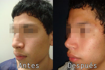 Cirugia Estética nariz en Clinica BMS